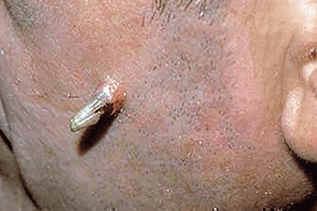 The animal-like horn on the side of this man's face is an actinic keratosis