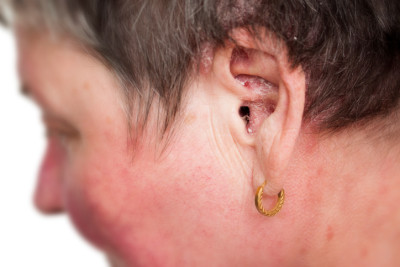 Psoriasis on a woman's face and ear