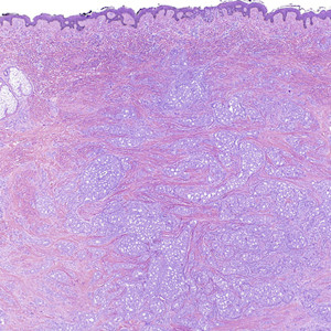 Histology card image of squamoid eccrine ductal carcinoma