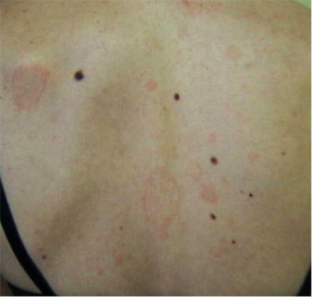 Pityriasis rosea large patches