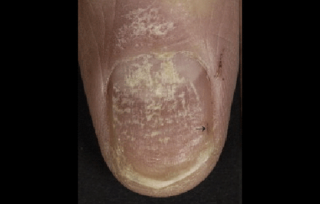 nail psoriasis causing crumbing and rough nail