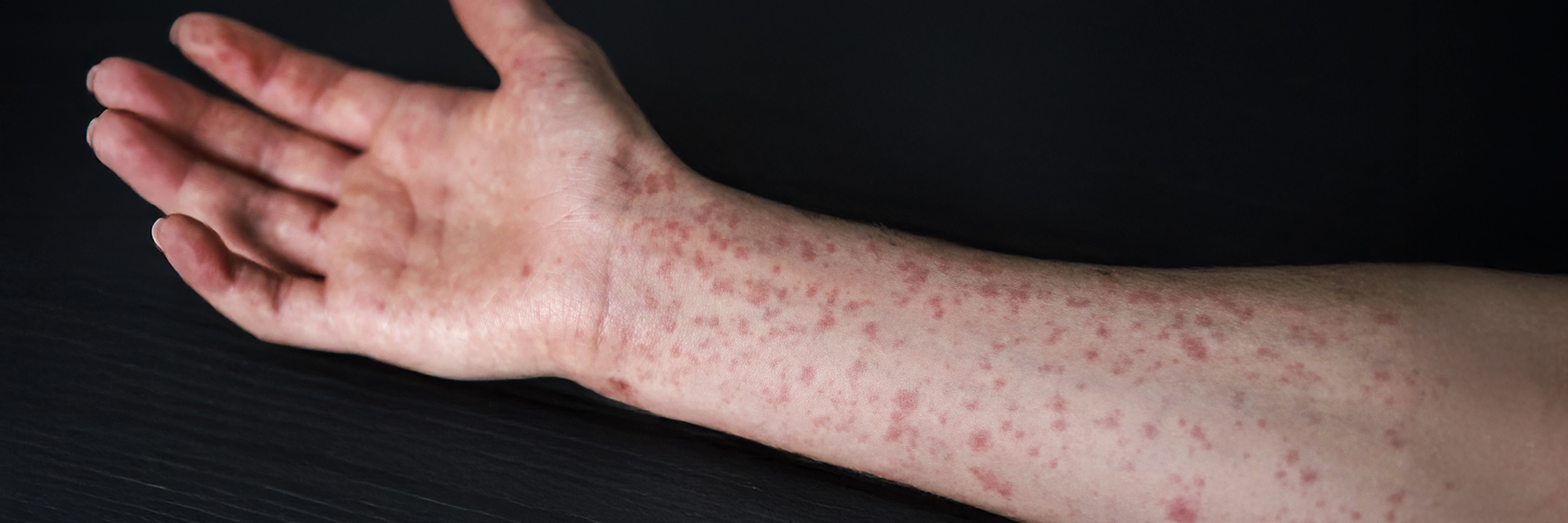 Banner image for New measles resource center helps dermatologists manage outbreak