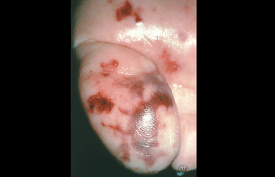 Brown discolorations on bottom of foot are Janeway lesions