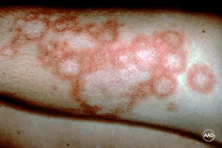Subacute cutaneous lupus rash on legs