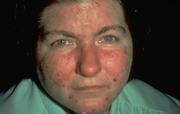 woman with acne rosacea