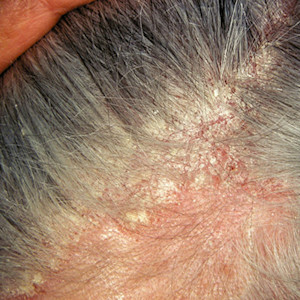 Card image for DWII about erectile dysfunction in dermatology, showing dermatitis of the scalp | American Academy of Dermatology (AAD)