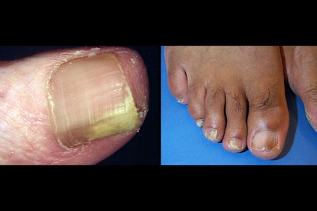 Image left: Nail fungus caused the whitish yellow discoloration on this nail; Image right: Brown discoloration on big toe due to nail fungus