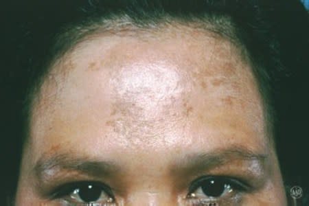 Melasma on a woman's forehead