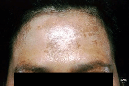 Melasma on patient’s forehead