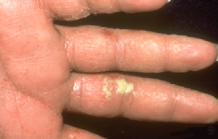Dyshidrotic eczema blisters