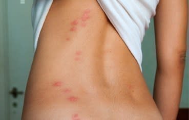 Bed bug bites often appear in a zigzag pattern