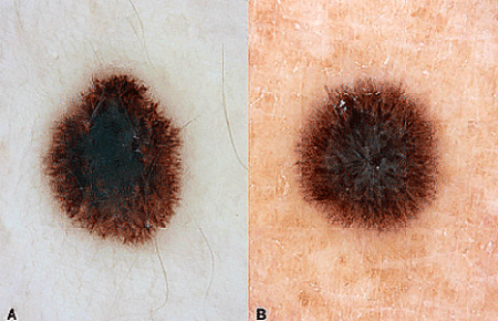Comparison image of a spitz nevus mole and melanoma