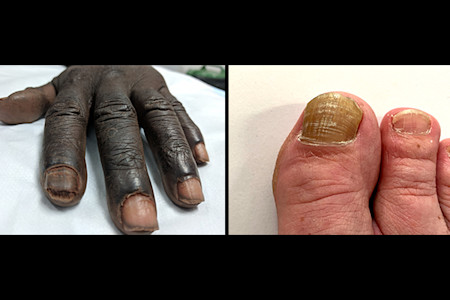 Image left: Nail fugus caused the entire fingernail to thicken and turn dark brown; Image right: Nail fungus caused the entire toenail on this big toe to thicken and turn yellowish brown.