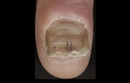 nail grooves and nail lifting up due to nail psoriasis