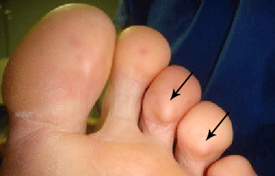 Painful lumps on toes are called Osler nodes