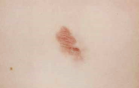 This raised, reddish-brown patch is a rare skin cancer called dermatofibrosarcoma protuberans 