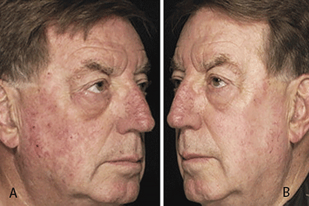 Images of a man before and after treatment for actinic keratosis