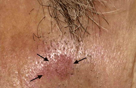 The reddish, pink patch below this man's sideburn is an actinic keratosis