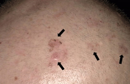 Close-up of early skin cancer on scalp