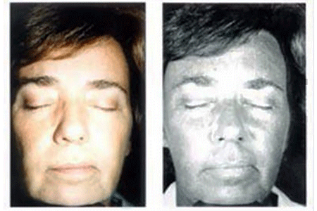 Prematurely aged skin from UV sun damage on face of 52 year old woman