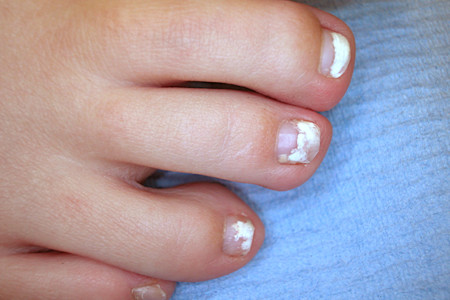 White nail fungus on three toes