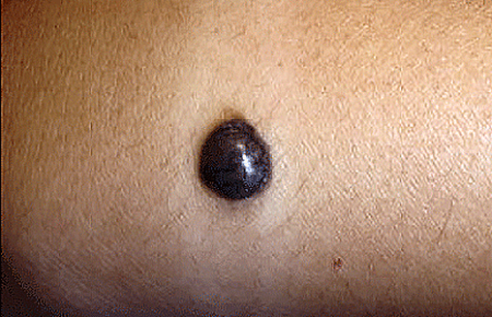 Melanoma on a girl's arm