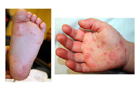 Hand-foot-mouth disease on soles and palms of a child