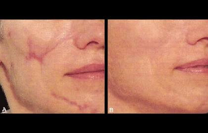 woman's face before and after pictures of laser treatment for scars