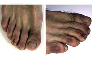 Patient with COVID toes