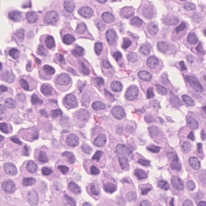 Card image for DWII of a microscope slide of eccrine mucin-producing sweat gland carcinoma