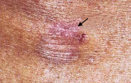 Reddish brown patch of raised skin that looks like a scar is the first sign of dermatofibrosarcoma protuberan skin cancer