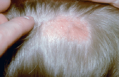 Nevus sebaceous on child's scalp