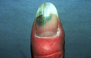 Infection under nail