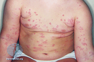 Hives on a child's body