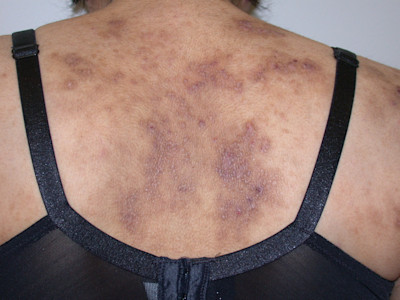 DWII illustration for nemolizumab