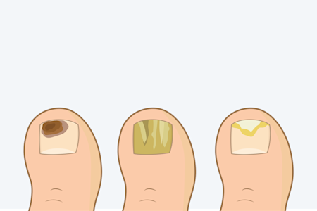 Toenail mycosis types illustration