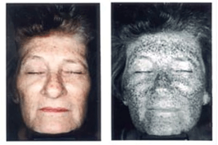 Extensive UV sun damage on 64 year old woman's face