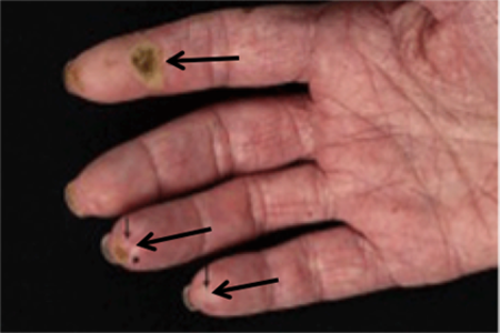 Sores and calcium deposits on fingers from scleroderma