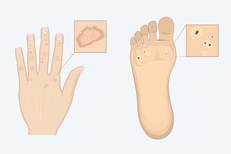 illustrations of warts on hands and feet