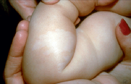 White spot birthmark