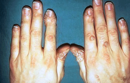 Warts on the hands of a woman