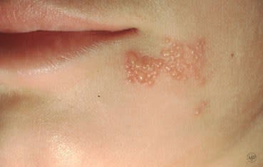 Herpes simplex sores around the mouth