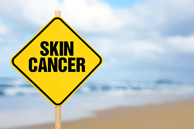 Skin cancer on a yellow warning sign with wooden post at the beach