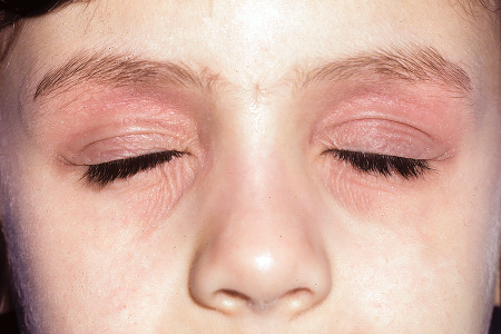 Thickened, pinkish skin around woman’s eyes due to atopic dermatitis