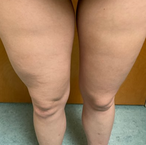 Card illustration for DWII on Lipodystrophia semicircularis