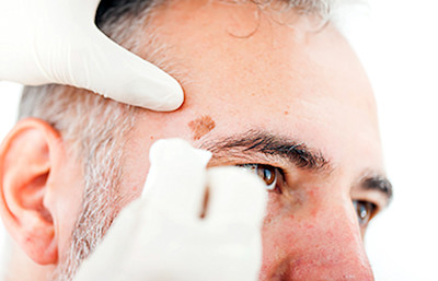 Man getting examined for skin cancer.