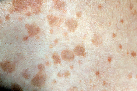 Tinea versicolor spots on the skin