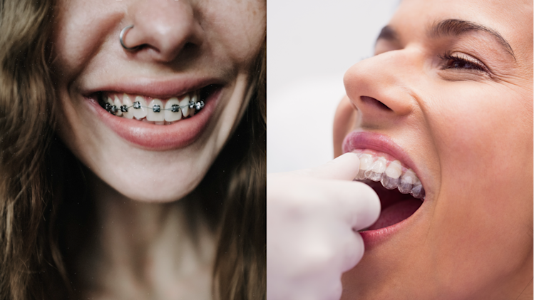 ¿Ortodoncia Invisible o Brackets?