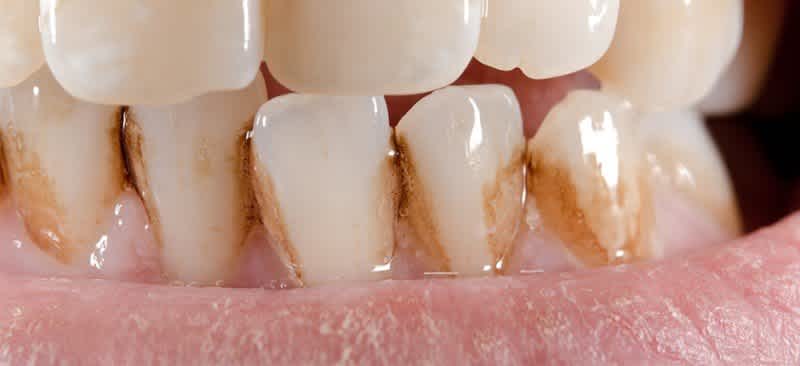 ¿Cómo tratar los dientes con manchas del café?