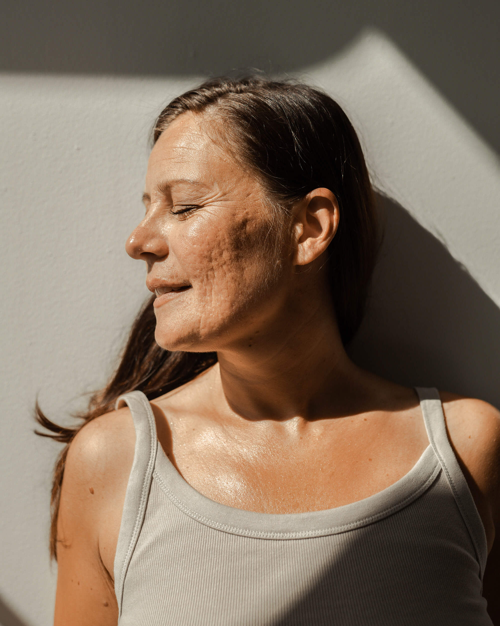 En person med slutna ögon som visar defekter i ansiktshuden